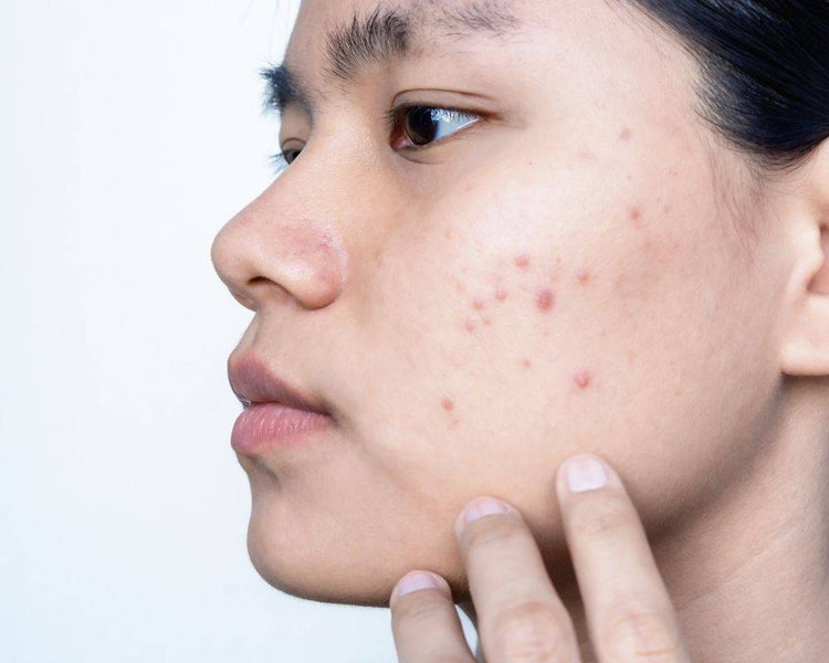 What Is The Difference Between Teenage and Adult Acne?