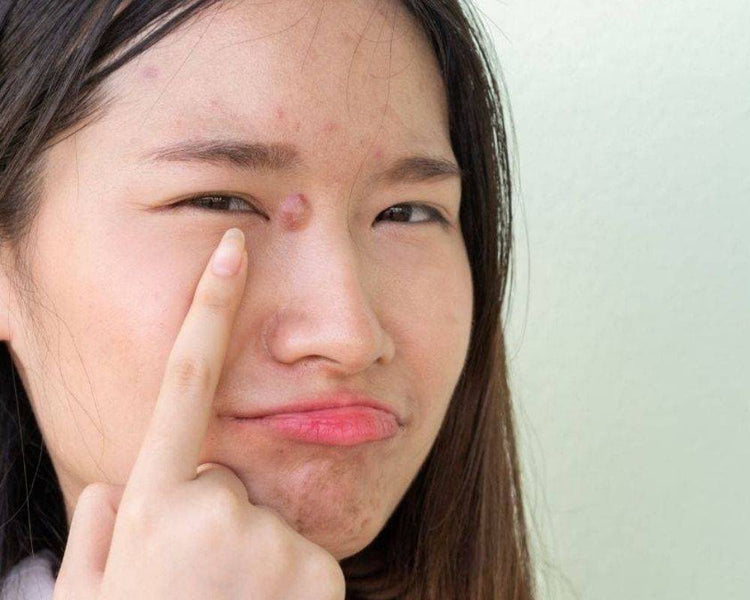 Cystic Acne: Causes, Triggers and Treatments
