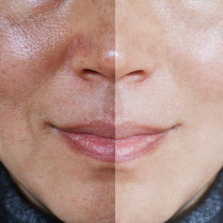 Ask a Skin Expert: How Can I Treat Pigmentation?