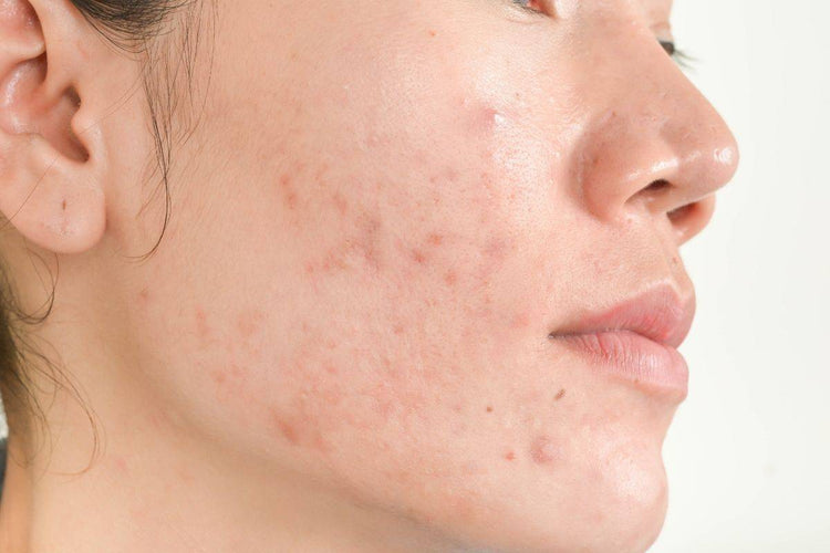 Adult Hormonal Acne - Causes, Triggers and Treatments