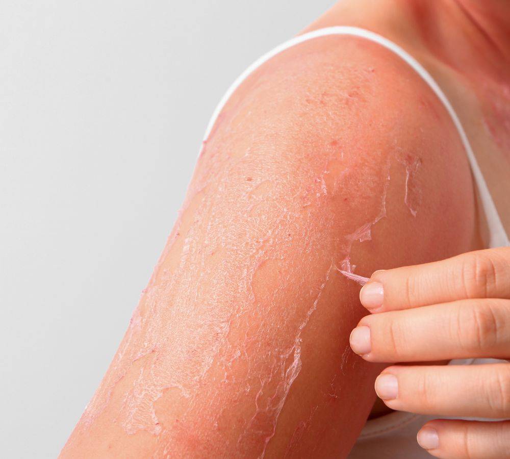 Sunburn - What Really Happens to Your Skin