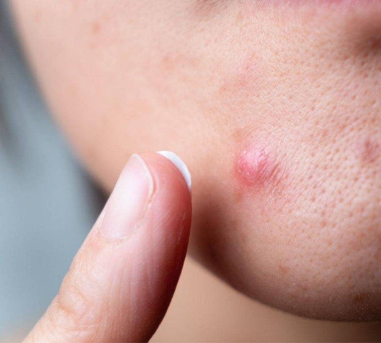 The 9 Triggers of Acne and How to Prevent Them