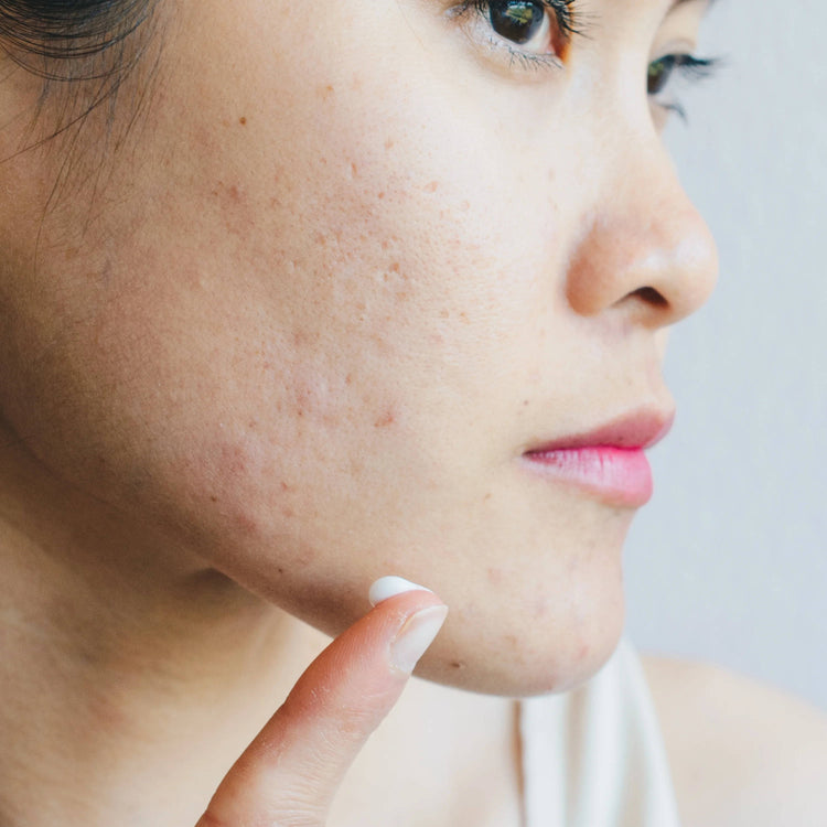 How to Get Rid of Chin Pimples