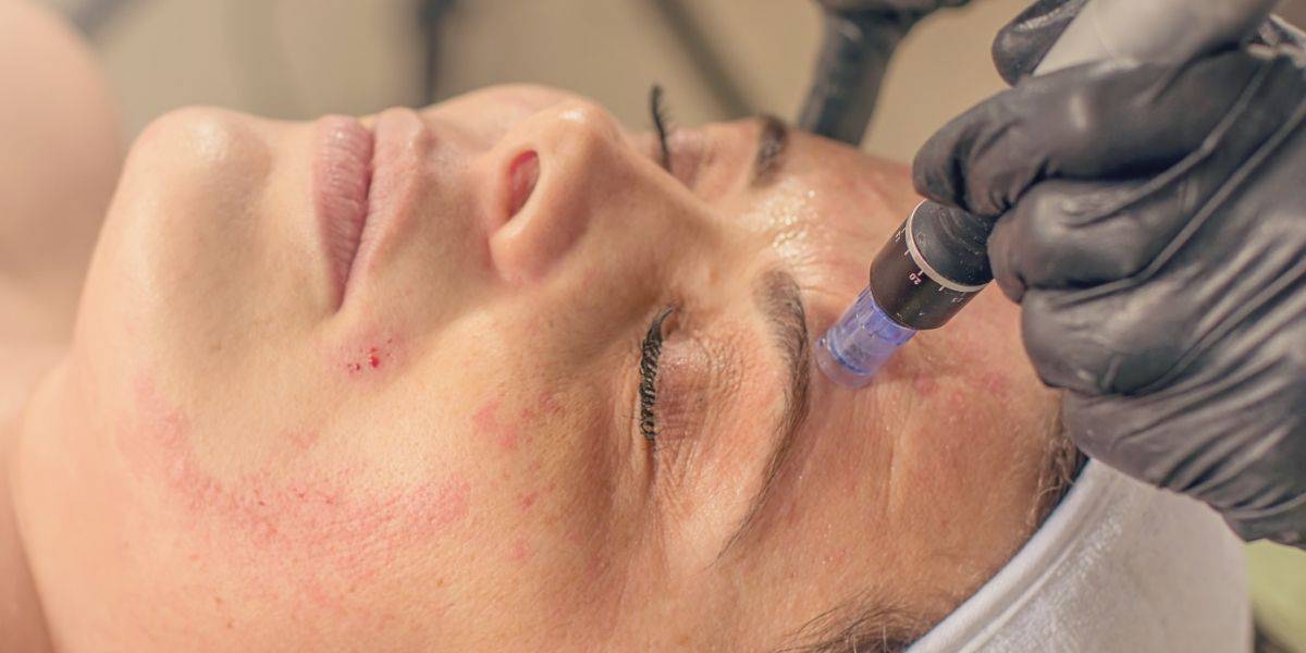 Why Skin Needling is My Absolute Favourite Treatment