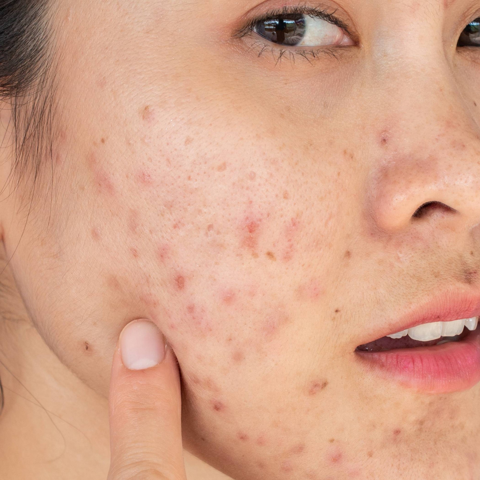 The 6 Different Types of Acne and How to Treat Them