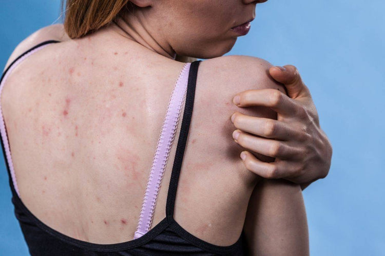 How to Treat Keratosis Pilaris