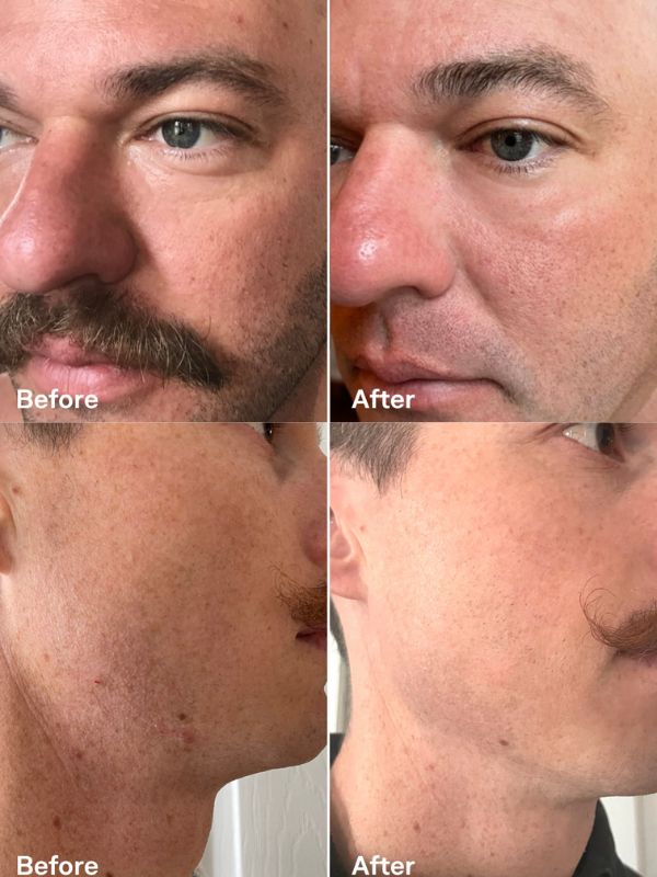 Omnilux Men - Refurbished